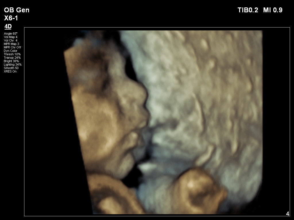 ultrazvucni snimak bebe